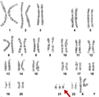 Gambaran kromosom pengidap kelainan kromosom sindrom down.