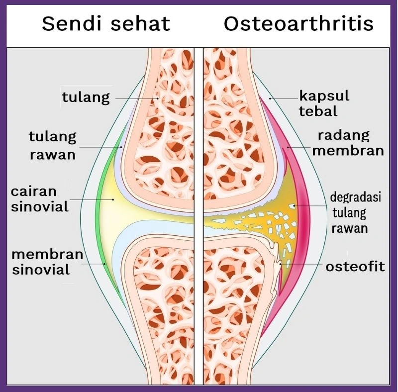 Ilustrasi perbedaan sendi sehat dan penderita osteoarthritis.